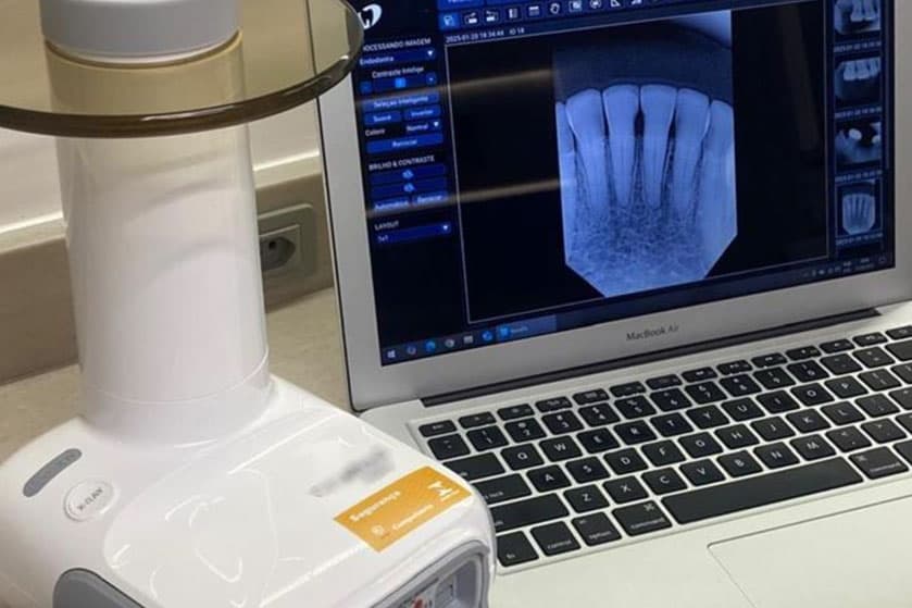 Sistema de raio-X digital odontológico com sensor portátil e imagem na tela do computador